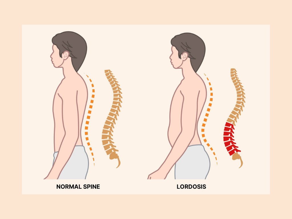 omdocpro's tweet photo. Restless Legs: The Lumbar Lordosis Factor.

Clinical evidence links Restless Legs Syndrome (RLS) to mechanical dural tension. Excessive lumbar lordosis (lower back curve) creates chronic shortening of posterior tissues, irritating the spinal dura mater. The urge to move is often a neurological response to this compression. Treating legs while ignoring spinal architecture is a fragmented strategy.

As a Specialist Manual Therapist, I address these mechanical drivers. My objective is to resolve structural conflicts in the lumbar-pelvic region. By restoring functional precision to your spinal curves, we neutralise the tension on the neural sheath, facilitating relief without long-term medication.

To map these deviations accurately, I must observe your architecture. Clinical protocol: UNDERWEAR ONLY (briefs/knickers, bra for women). I refuse to work blind; towels mask pelvic tilts essential for identifying the root cause. This ensures a deep, effective, yet painless intervention based on 35 years of clinical expertise.

As a Rehabilitation Specialist, I coach bespoke movements to stabilise your posture. For Remedial Massage Berwick, let’s find the source.

Expert Manual Therapy Berwick-upon-Tweed.
Bookings via WhatsApp or SMS only.

https://t.co/wScQW092rx