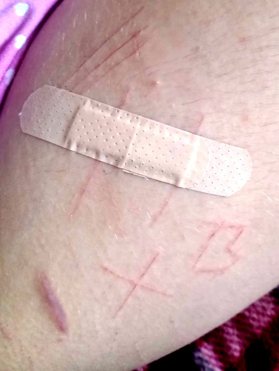 c3meterycoffin's tweet image. the cuts ㅤㅤㅤㅤㅤㅤㅤㅤㅤㅤㅤㅤthe aftercare #shtwt #slittwt