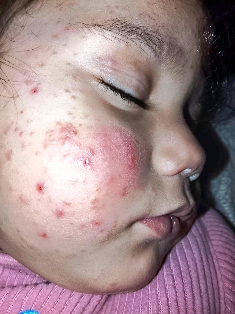 I'm not ashamed to say this: my daughter has contracted a contagious skin disease (scabies). She's in a lot of pain and cries because she's isolated from other children. She needs treatment and medication. Please help her
gofund.me/2e0da262e
Or
paypal.me/mohajayyab