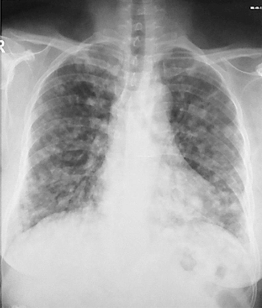 PeterItebimien's tweet image. A 50yr♂️ presented with chronic cough X 2 months,bloody sputum,chest pain and SOB.CXR done👇He was previously treated for TB,but symptoms have not improved.He reports eating undercooked fresh water crabs
#MedTwitter #MedX #MedEd #FOAMed #GITwitter #IDTwitter #CardioTwitter