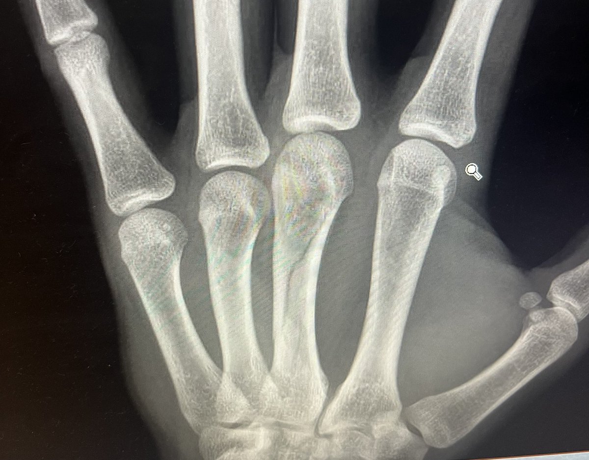 b_wads17's tweet photo. Third at-bat of the season: grand slam… broke my hand sliding into the catchers foot at home plate🤦‍♂️ 4-6 weeks recovery time. https://t.co/3nBkiwK70T