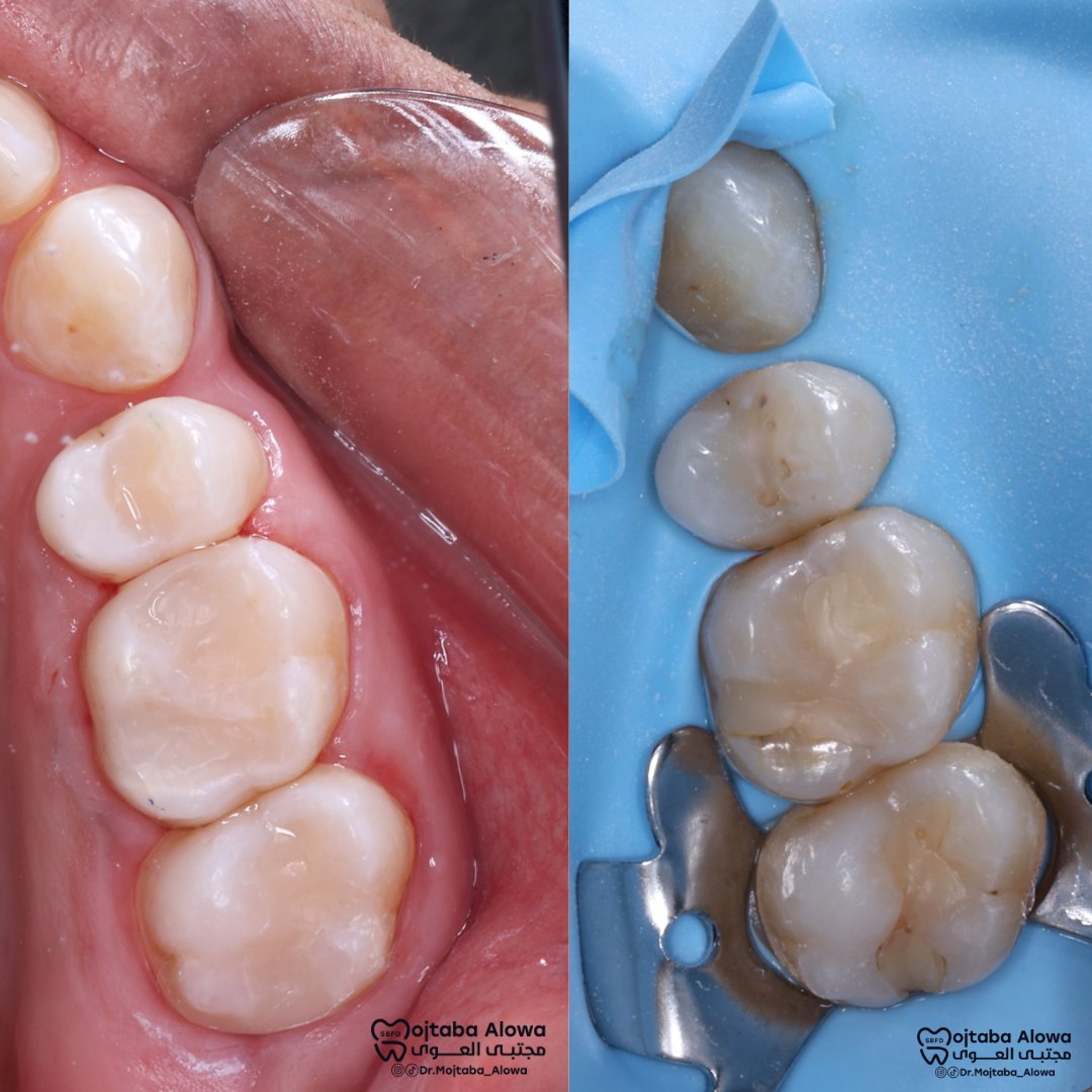 Dr_MojtabaAlowa's tweet photo. #classII #composite #restoration
#dental #tips #اسنان #حشوات https://t.co/pj0gsy7e6P