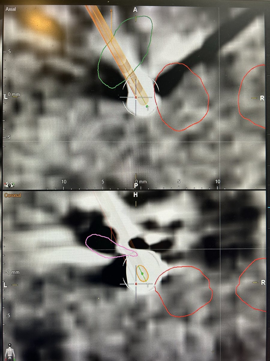 doktertremor's tweet photo. Targeting the VIM-PSA/cZi on Tremor-dominant Parkinson’s Disease. 
Thanks to Elements, planning station of @Brainlab!

Legends:
Red: Nucleus Ruber/Red Nucleus
Green: Subthalamic Nucleus/STN
Pink: Ventral Intermedius/VIM Thalamus https://t.co/DeMaVbGsKA