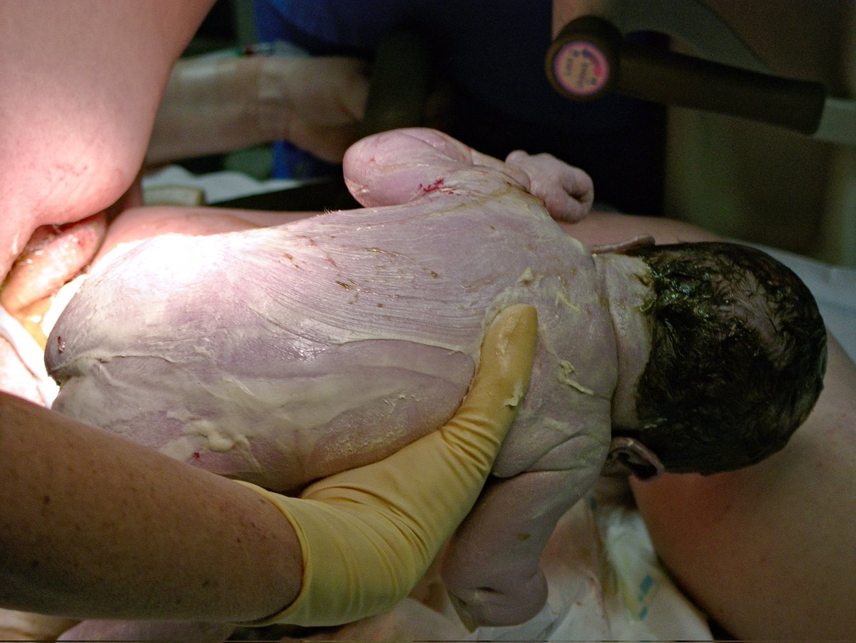 RealSaintEmma's tweet photo. Let's learn about this:
VERNIX CASEOSA:  This is a protective biofilm that coats the skin of a fetus especially during the third trimester of pregnancy. https://t.co/q1Nhde7EeS