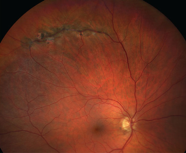 revoptom's tweet image. Pediatric Myopia Linked to Elevated Risk of Peripheral Retinal Pathology, New Study Finds

Kids with ≥3D of myopia face greater odds than their non-myopic peers, underscoring routine dilation in young patients.

reviewofoptometry.com/article/pediat…

#optometry #eyecare #pediatrics #myopia