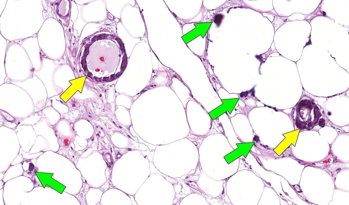 JMGardnerMD's tweet image. Painful black ulcer. Abdomen of dialysis patient. Diagnosis? 
Answer ✅ youtube.com/watch?v=fESY7h… 
#Dermatology Emergencies all #Pathologists should know: youtube.com/watch?v=EFxAli… 
#pathology #pathTwitter #dermpath #dermtwitter