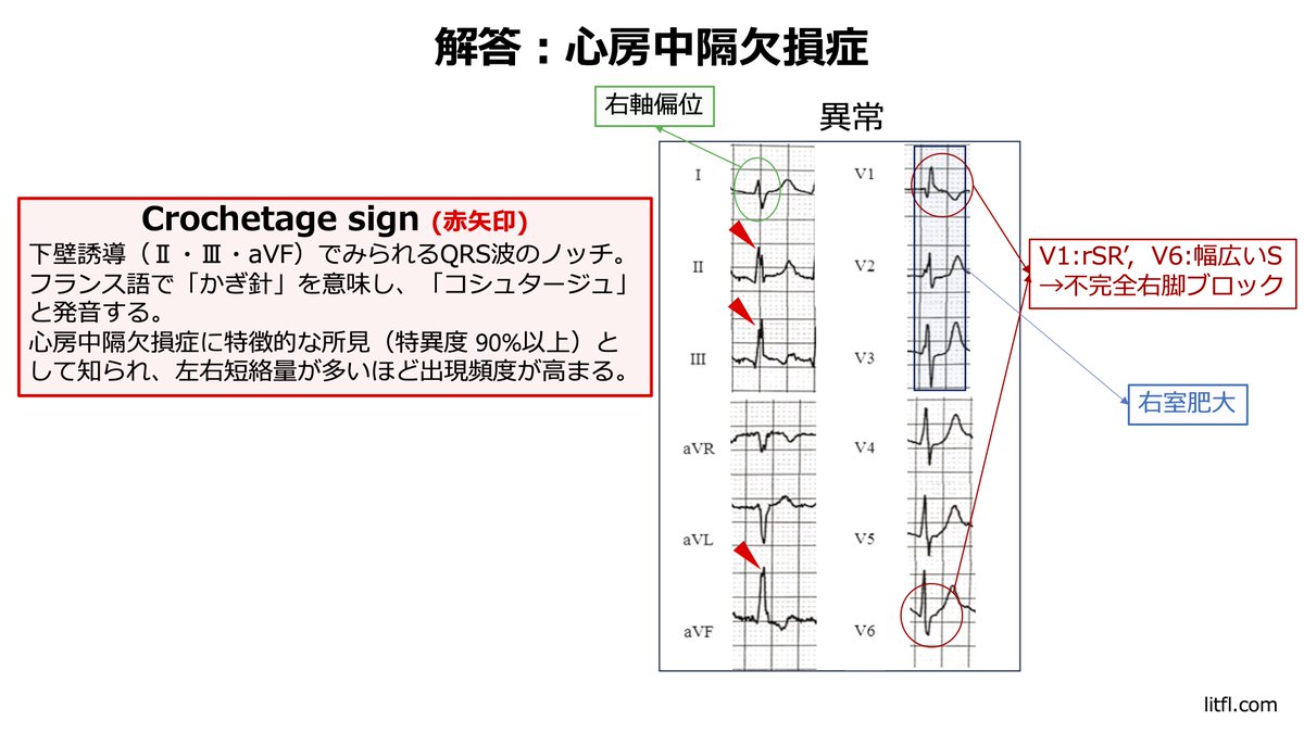 kobe_junnai's tweet image. ⼼電図マスターへの道
 神⼾⼤学不整脈グループが、⼼電図の系統的な⾒⽅を解説︕👀

今回は「⼼電図診断の実践編」パート2

第12回は「QRSに潜む異常②」📈🔍

しっかり学んで⼼電図を極めよう︕💪#⼼電図#不整脈#QRS #医療 #循環器