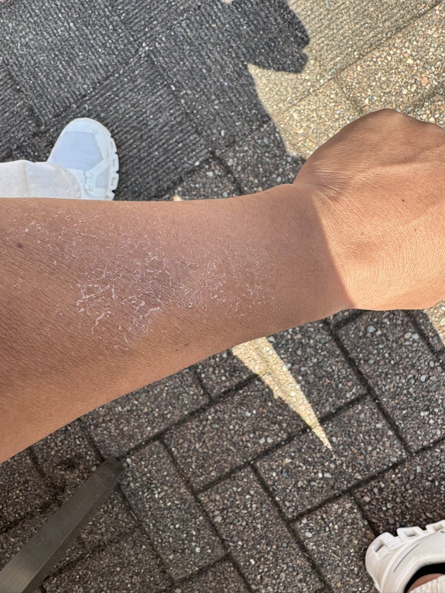 爺いになると肌が汚く見えるよね
もう皮剥けた笑

スキンケアちゃんとしないとダメね