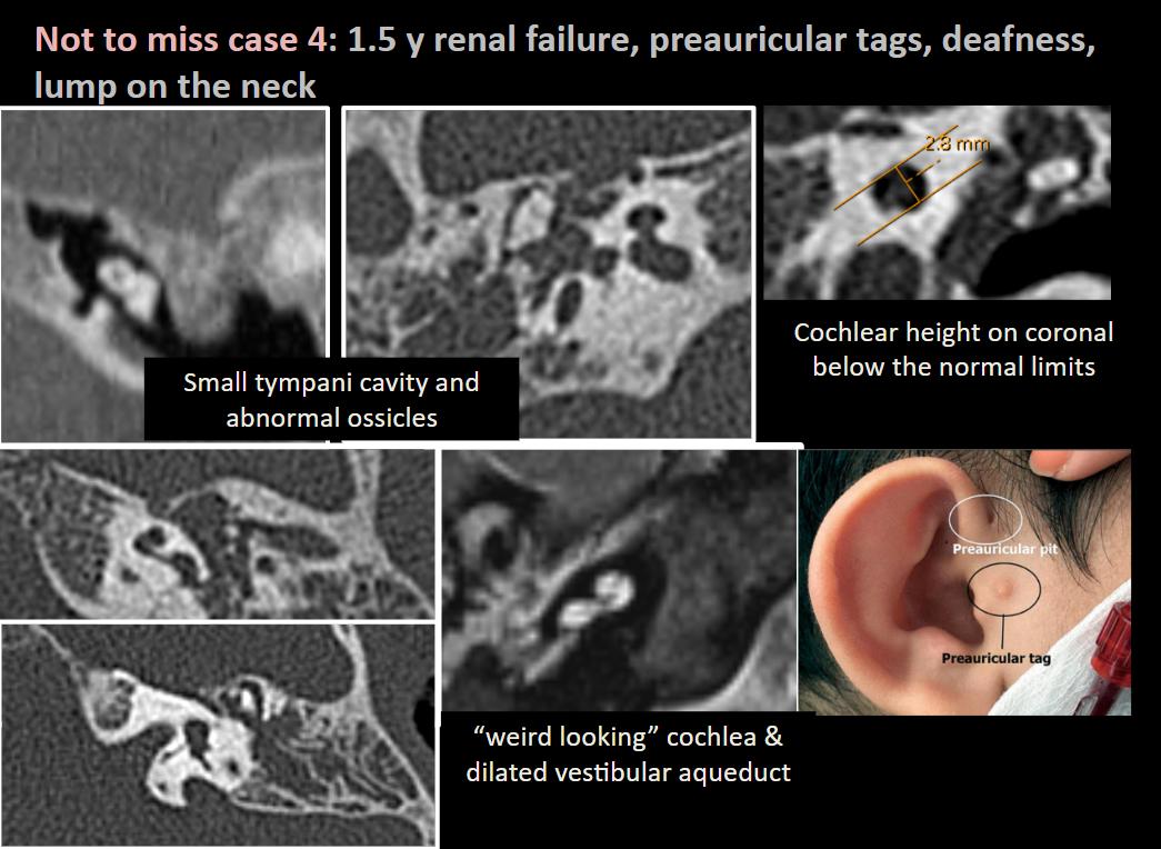ESHNRSociety's tweet photo. 🎯Join the upcoming ESHNR webinar!
📅 April 28 | ⏰ 18:00 CEST
🦻Advanced Imaging of inner ear malformation
▶️Speaker: @FeliceDArco 
▶️Moderator: @Bert_DeFoer 
🔗 Register: https://t.co/9kVZA8qj42
📖 Related reading: https://t.co/3d2nxxYns3
👀 A sneak preview of the talk! https://t.co/cORm0Hv2hQ
