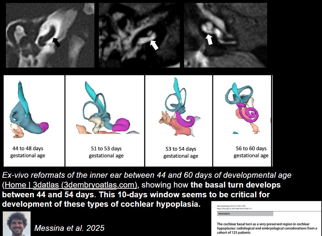 ESHNRSociety's tweet photo. 🎯Join the upcoming ESHNR webinar!
📅 April 28 | ⏰ 18:00 CEST
🦻Advanced Imaging of inner ear malformation
▶️Speaker: @FeliceDArco 
▶️Moderator: @Bert_DeFoer 
🔗 Register: https://t.co/9kVZA8qj42
📖 Related reading: https://t.co/3d2nxxYns3
👀 A sneak preview of the talk! https://t.co/cORm0Hv2hQ