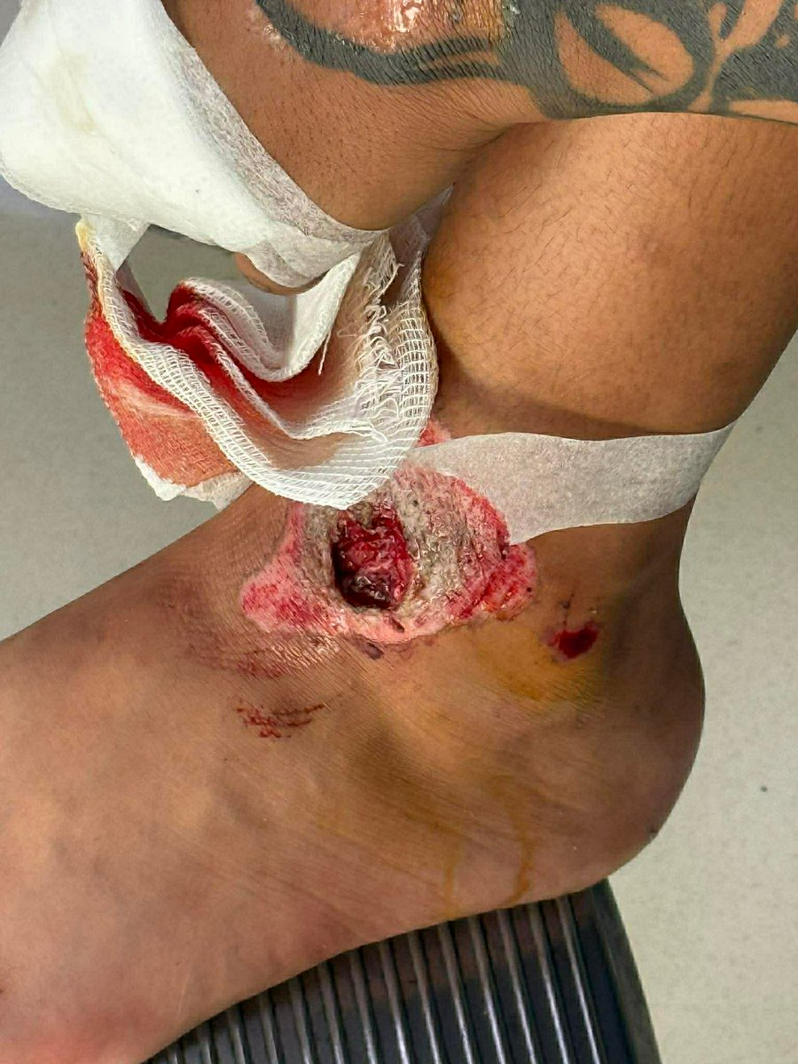 0xGlorbin's tweet image. Pay for my surgery hopefully. just had a pretty nasty motorcycle crash @ValkyrieXStudio #loveprod #wtrain

stake: GlorbinETH