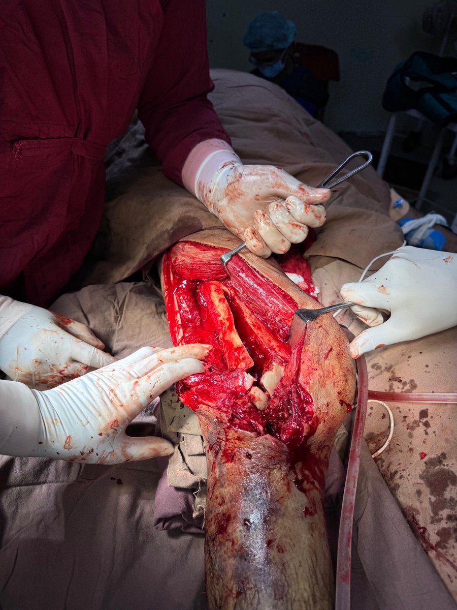suburb_monk's tweet photo. “Coronal plane challenge conquered 💪🦴—Hoffa fracture stabilized with compression + locking construct 🔩. Knee motion is key next 🔄🏃♂️ #Orthopaedics #TraumaSurgery #HoffaFracture #ORIF #FractureFixation”
“When anatomy is restored, function follows ✨🦴. Hoffa + distal femur ORIF 🔩💯