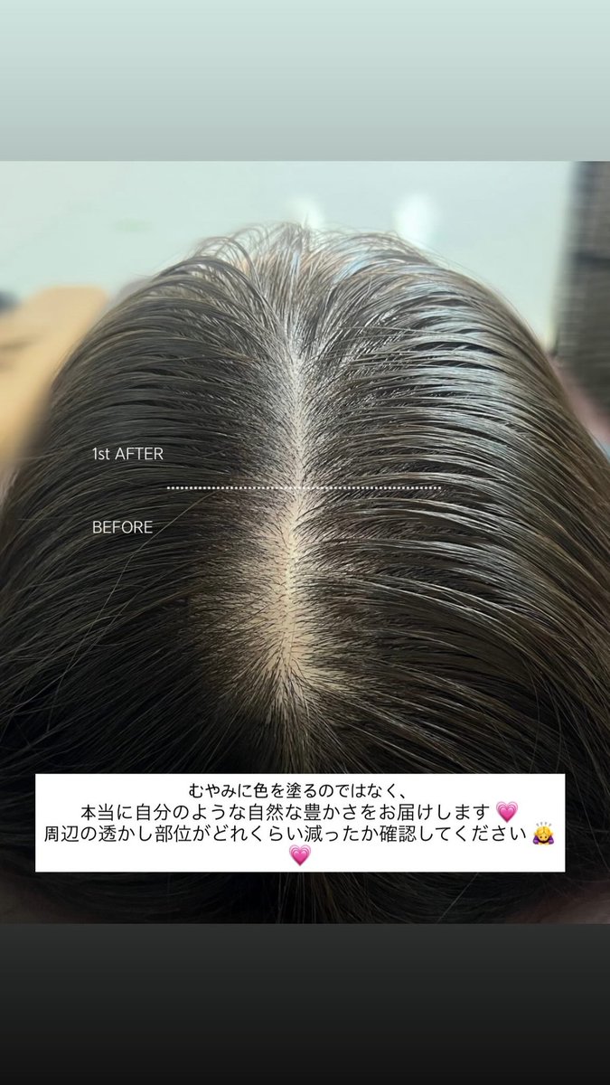 jayu_artmake's tweet photo. SMP(頭皮アート)は脱毛カバー/美容/傷跡カバーなど様々な 
目的に行われる頭皮カバー施術です:) 

毛根を表現して施���するので、とても自然で確実な効果を保障するのが特徴です。

頭皮アートは頭皮のタイプによって異なりますが、平均的に2年以上維持されます。 より長い維持期間をご希望のお客様は2回以上の施術をお勧めします。

無刺激/無痛症に近い施術で、毛包に刺激を与えない安全な施術で、時間/費用に比べて高い効果を感じることができます:)

#頭皮アート #脱毛治療 #脱毛 
#眉毛アート #ヘアラインアート #韓国整形 #韓国皮膚科  #アートメイク #眉毛アートメイク #ヘアラインメイク
