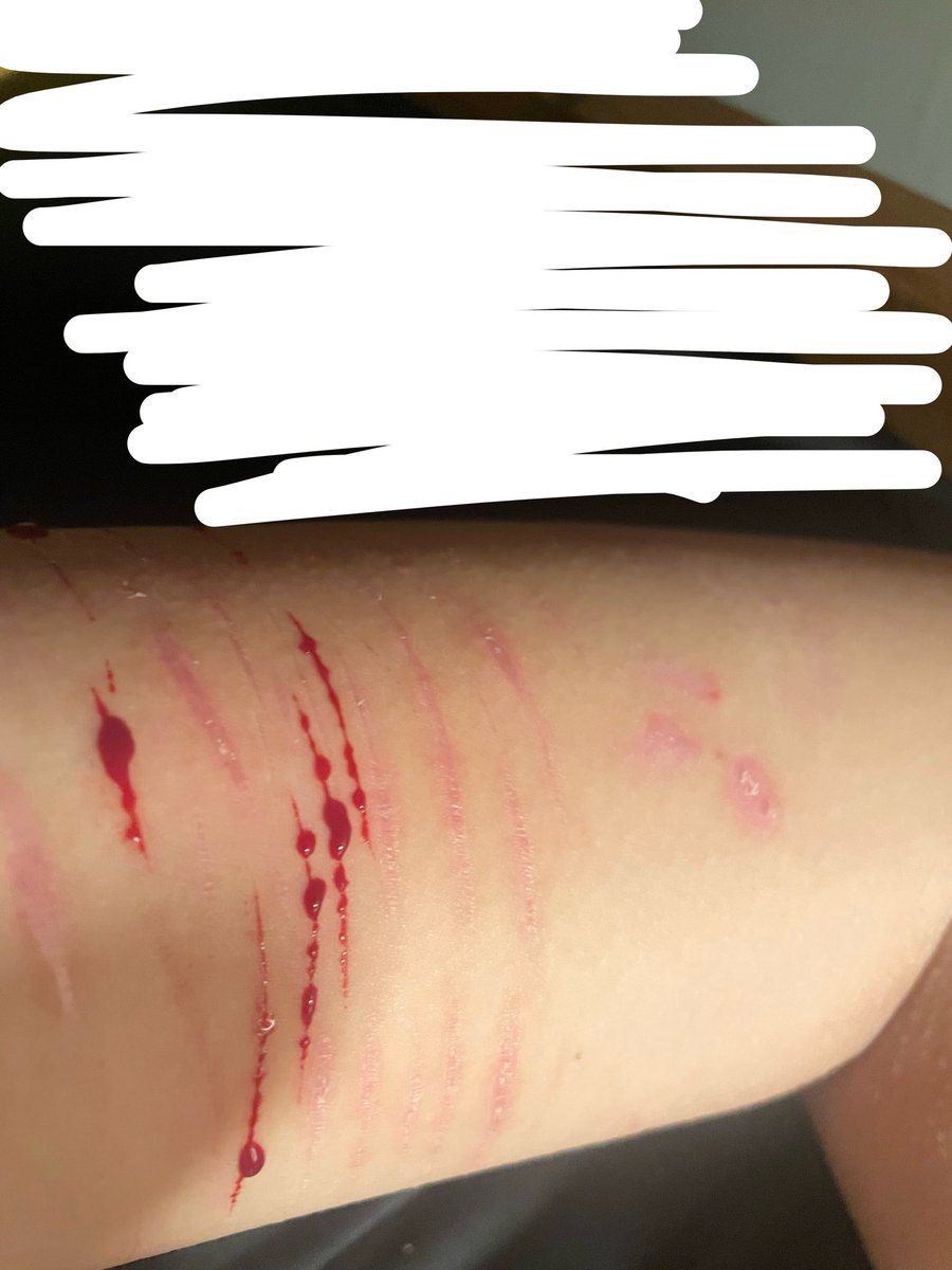 puso_in_dahouse's tweet image. scars and cat scratches :))  #slittwt #shtwt #catscratches #babystryo #scarspo