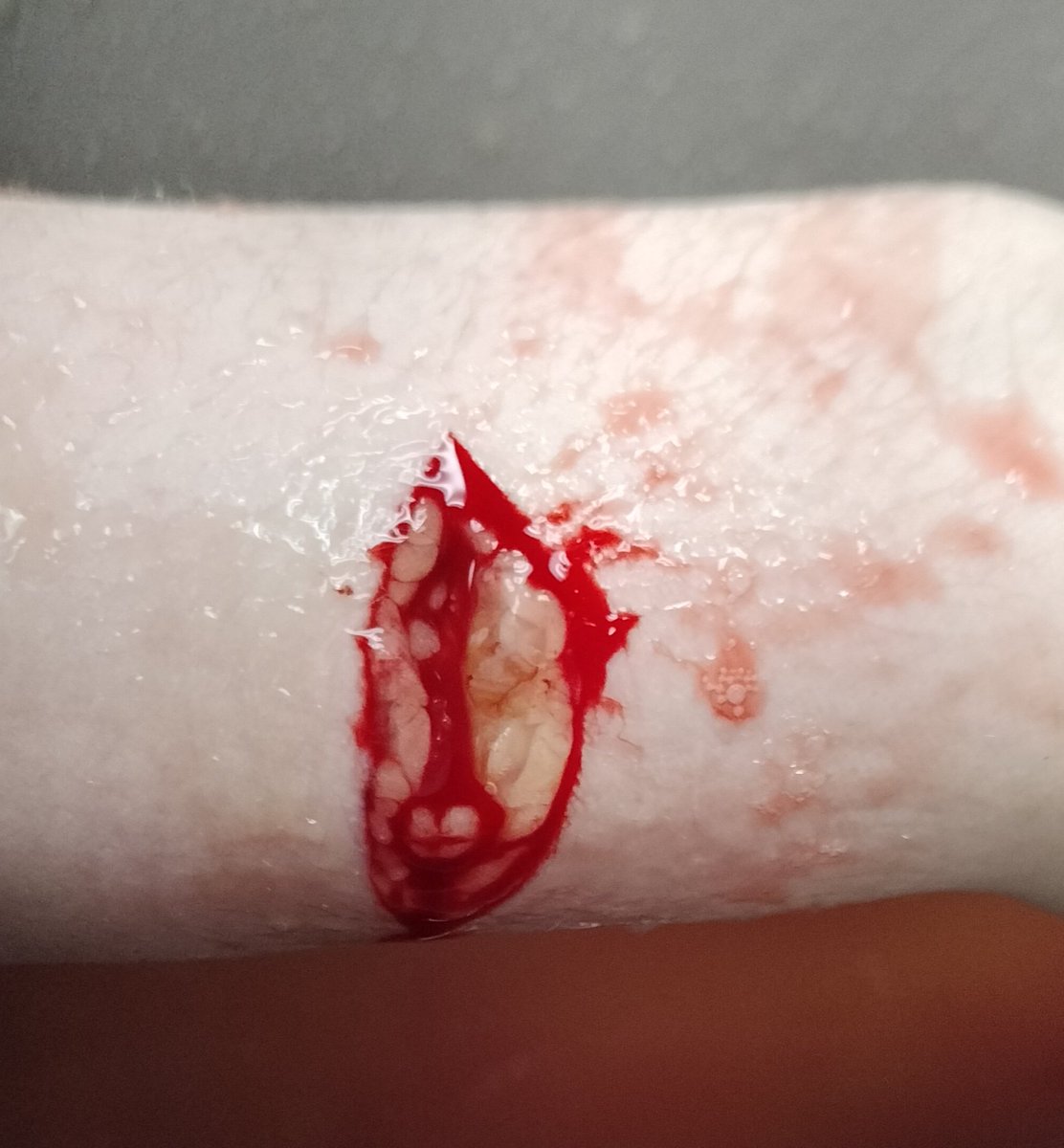 c0nection's tweet photo. cw sh ///

reposting my fav and deepest bc i haven't done shit in a while
visible fascia n vein but this was after they flushed it so you can't see it 💔 was too panicked to take a before pic 
#shtwt #988twt https://t.co/0ONB0bnkRz