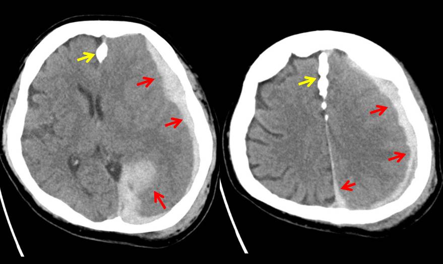 ManualOMedicine's tweet image. A 59 y/o man presented after a fall at home. Examination showed GCS 15/15 and no neurological deficit. Patient was discharged home. 
He presented again after 2 days with severe headache and vomiting.
- What’s the diagnosis ?

#medtwitter #foamed #foamrad