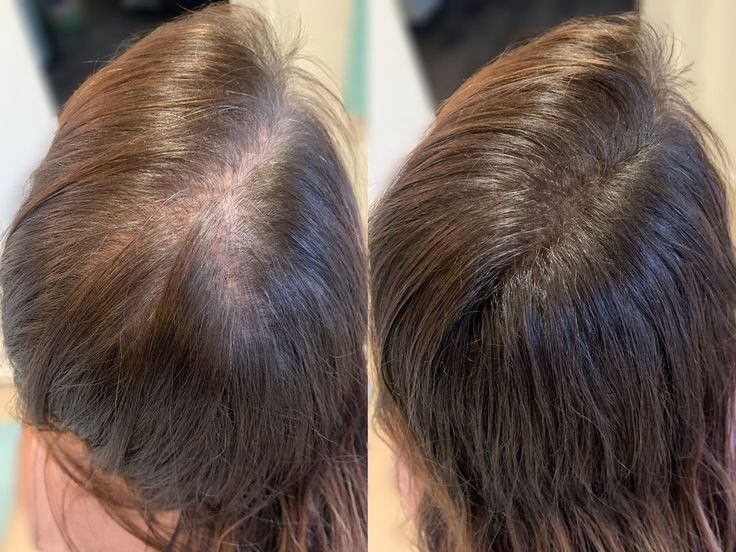 urpumpkinns's tweet photo. Fase Paling Nyebelin Tuh Pas Rambut Lagi Rontok Parah 

Keramas rontok, disisir pun rontok, bahkan di lantai kamar juga ada aja. Akhirnya coba bandingin beberapa shampoo anti yang hairfall, ini versi aku https://t.co/qzfjZEOhQa