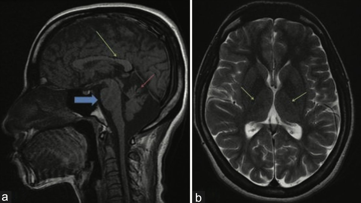 Annals of Indian Academy of Neurology tweet media