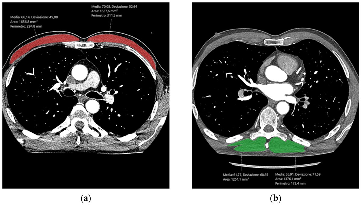 Tomography_MDPI's tweet image. ✨ Editor’s Choice 🪄📑
🫀 Article: "Correlation of Sarcopenia with Coronary Artery Disease Severity and Pericoronary Adipose Tissue Attenuation: A Coronary CT Study"

🔍 brnw.ch/21x1XVY

#Tomography #Sarcopenia #CoronaryArtery #Angiography