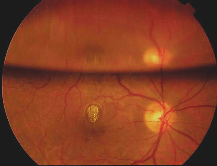 drgunjand's tweet image. Reflection in a gas tamponade.

#MedTwitter #ophthalmology #neetpg 
Image google