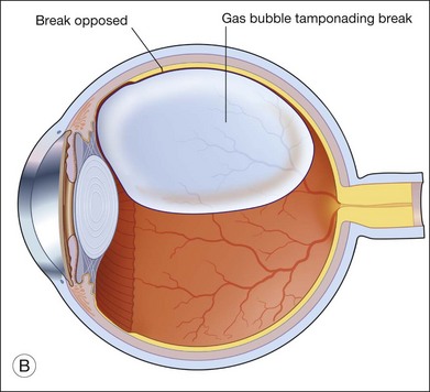 drgunjand's tweet image. Reflection in a gas tamponade.

#MedTwitter #ophthalmology #neetpg 
Image google