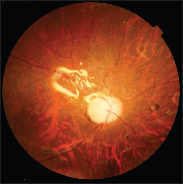 drgunjand's tweet image. Post-vitrectomy with silicone oil in situ.

#MedTwitter #ophthalmology #neetpg 
Image @vrmnyc