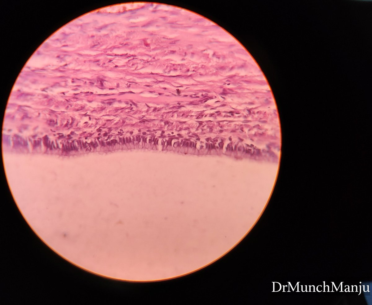 MunchManju95's tweet image. Comment on the ovarian cyst.
What epithelium do you see here?
#pathresidents
#learnpathologywithmanju 
#histopathbasics
#pathreporting
#pathx
@ManjulaNavamani