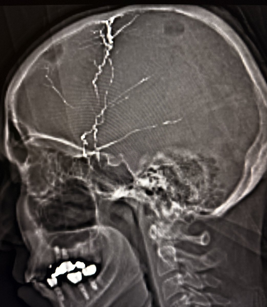 samrad77's tweet photo. Quiz: Linear radiopaque material tracking along both sides of the skull on CT. What is it?

Answer: Post-procedural changes from middle meningeal artery embolization for chronic subdural hematoma.

Why we do it
•Chronic subdural hematoma is not just “old blood.” 
•It is a biologically active membrane disease.
•Outer neomembrane develops along the dura. 
•It is vascular, fragile, and fed largely by branches of the middle meningeal artery.
•Recurrent microbleeds and exudation maintain or enlarge the collection.
•Embolization shuts this supply → less rebleeding → lower recurrence.

Where it fits clinically
•Adjunct to burr-hole evacuation to reduce recurrence 
•Standalone in selected patients (mild symptoms, high surgical risk) 
•Recurrent or bilateral chronic SDH 
•Increasing use with growing evidence, but still evolving practice patterns 

—Pearls, pitfalls and wisdom from my reporting list