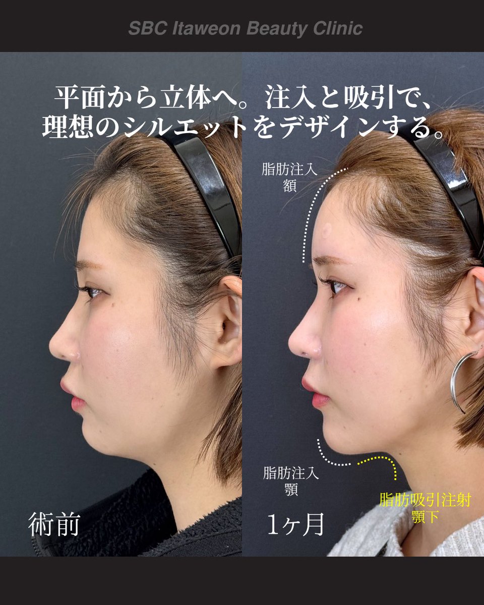 小顔輪郭整形 | 小顔KING(濱田純) / イテウォン名古屋栄院 tweet media
