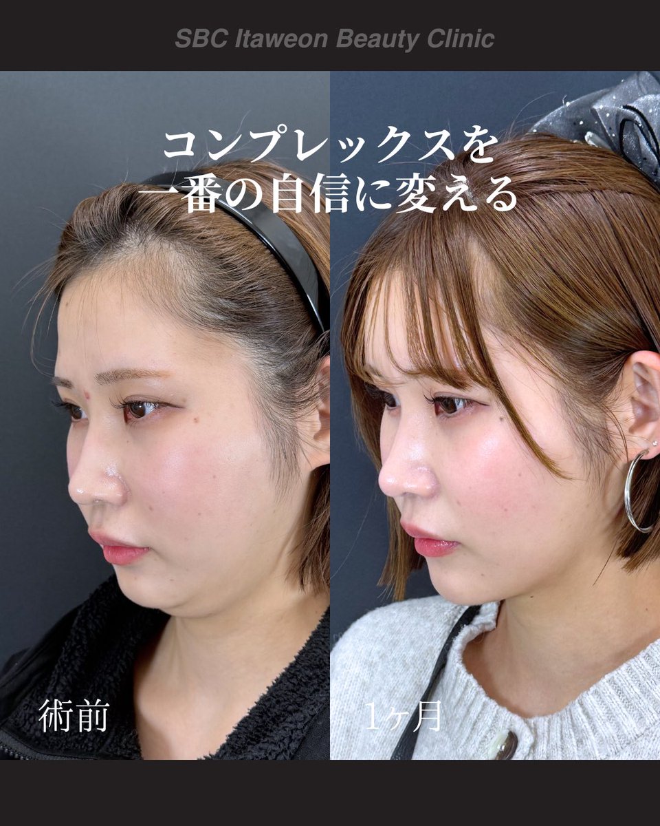 小顔輪郭整形 | 小顔KING(濱田純) / イテウォン名古屋栄院 tweet media