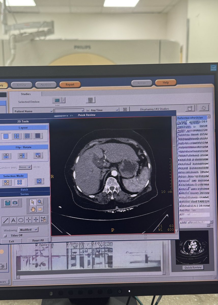 eio_vv's tweet photo. Night Shift ✨with Mesenteric Ischemia
أتعب وأنا اقول السي تي مكاني 🏃🏻🏃🏻 https://t.co/3U2udM66lq