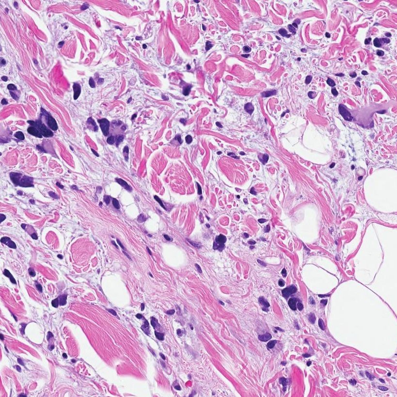 DrCycloPath's tweet image. #PathQuiz 🔬🥩 #SoftTissuePath

A) Atypical Lipomatous Tumor
B) Myxoid Liposarcoma
C) Nodular Fasciitis
D) Pleomorphic Lipoma

#Pathology #SoftTissuePath #DermPath