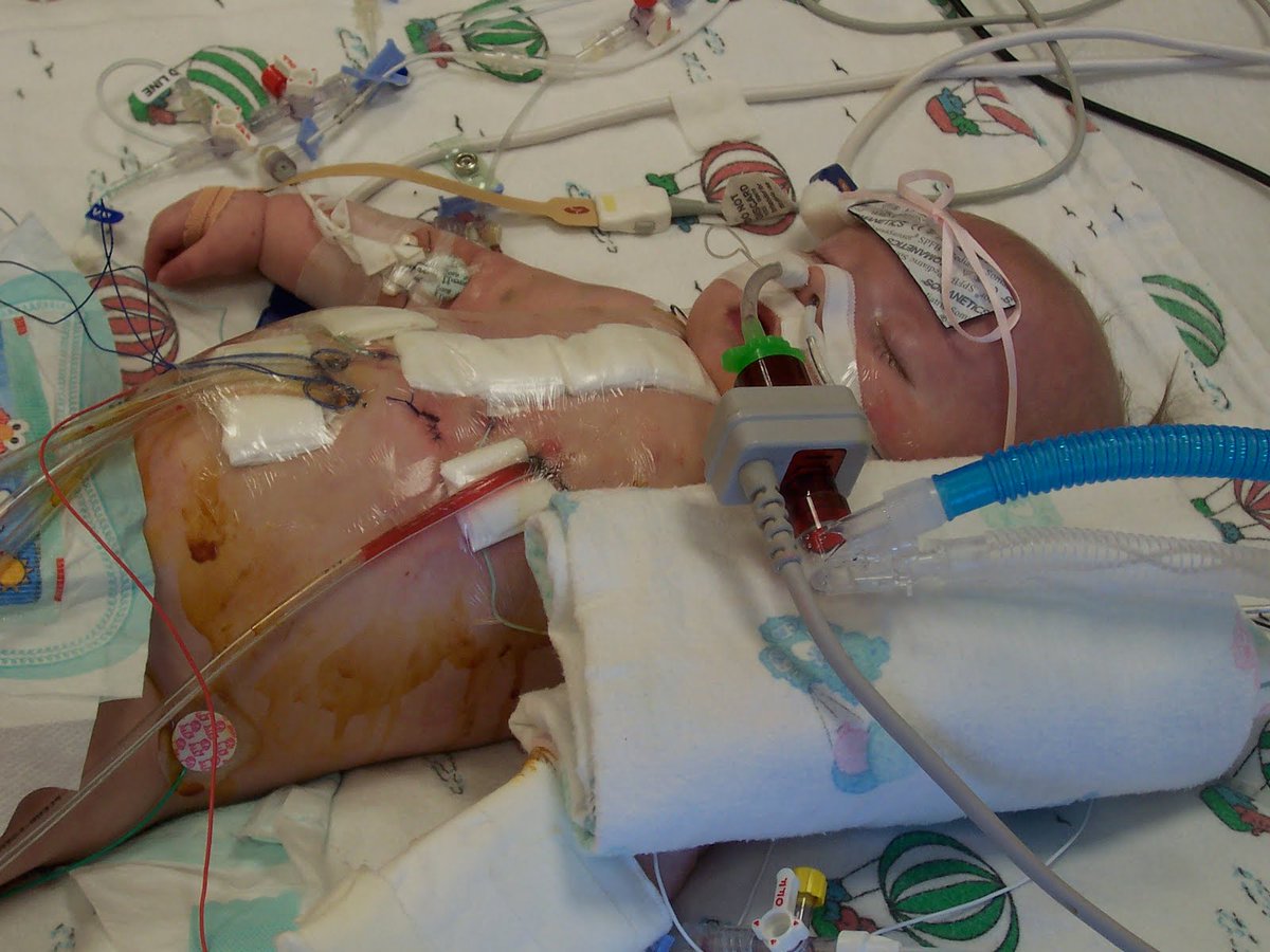 Emmoonsspired's tweet photo. From Zero days to Live, to 13 years old. 

I delivered Ruby, sucked fluid from her lungs, wrapped her blue body up in a towel and rushed her to a hospital. Got oxygen, ambulance to @childrenswi and learned of #CHD #ToF #22q and later #T1D feeding tubes &amp; surgery.

Crazy. PTSD. https://t.co/4vz1CSIx2w