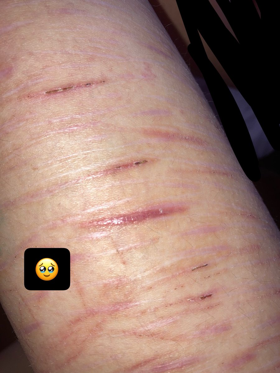 Juno_Cvts's tweet image. Look at my beautiful  MAKEUP #Fake #SFX #makeup
The butterfly and bug is fading 
Bby beans scar :3