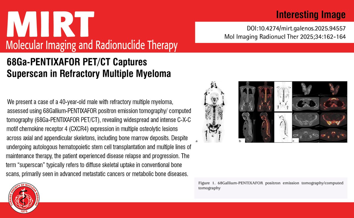 MIRTOfficial's tweet image. 68Ga-PENTIXAFOR PET/CT Captures Superscan in Refractory Multiple Myeloma
You can see the free full text of the research by Siven Kar et al.
Link : mirt.tsnmjournals.org/pdf/8a9ff4da-5…
#receptor4 #positron #emission #tomography #computed #tomography