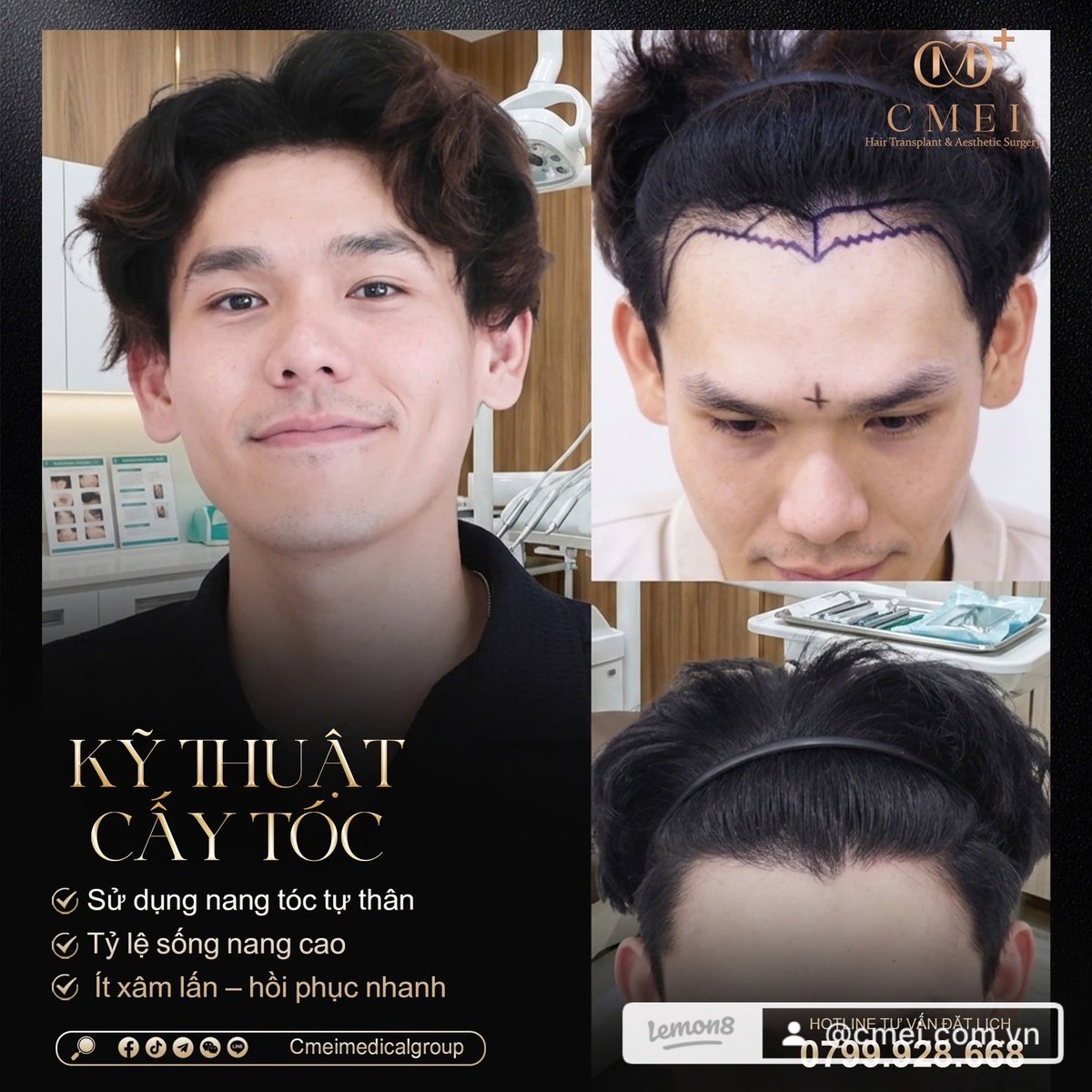 cmeimedical's tweet photo. 🏥 CMEI – 5-STAR INTERNATIONAL AESTHETIC CLINIC COMING SOON TO SAIGON

🔥 GRAND OPENING LIMITED OFFER 🔥
💥 HAIR TRANSPLANT ONLY 45 MILLION VND (FULL PACKAGE)

✔️ Latest advanced technology applied
✔️ Performed directly by doctors &amp; international experts
ho chi Minh City https://t.co/82UA5QnkKp