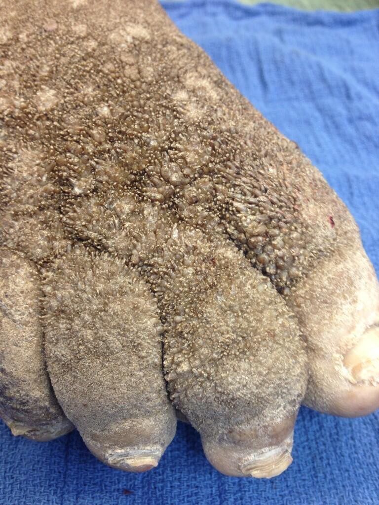 JMGardnerMD's tweet image. What's wrong with this foot???
More pics (warning: GRAPHIC): kikoxp.com/posts/11614
Answer ✅ youtu.be/oYqKbtPrF38?si… 
More cases: kikoxp.com/posts/11612 &amp;amp; kikoxp.com/posts/11613
#pathology #pathologists #pathTwitter #dermpath #dermatology #dermtwitter