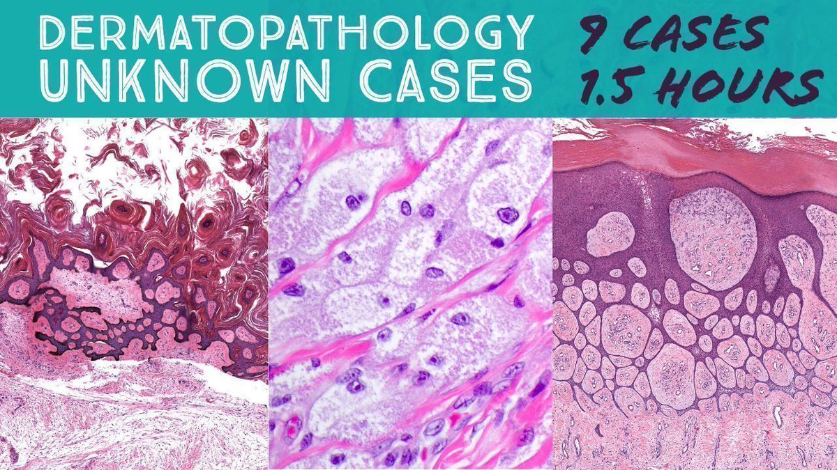 JMGardnerMD's tweet image. Dermatopathology Unknown Cases (for University of New Mexico UNM Dermatology Residents) Board Review. Video: youtube.com/watch?v=dm_26t… 
#pathology #pathologists #pathTwitter #dermpath #dermatology #dermatologia #dermtwitter