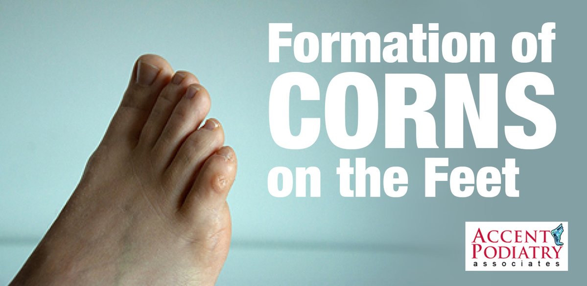 360careQPC's tweet image. Corns form when the skin thickens to repeated pressure or rubbing. Corns usually develop on the top or sides of the toes, or on the bottom of the foot. A podiatrist can safely remove thickened skin. #footcare #podiatry 360care.com
LEARN MORE: tinyurl.com/4v3x3ayp