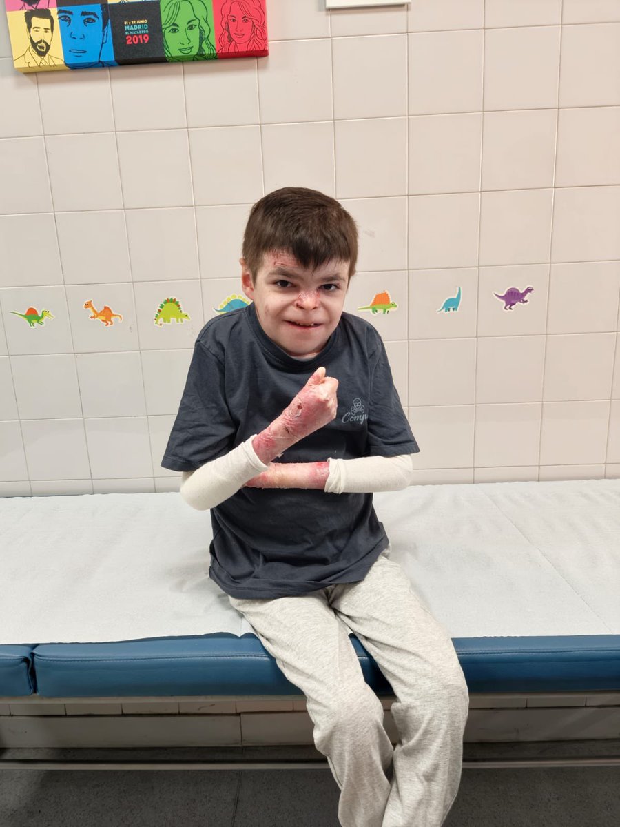 herqles_es's tweet image. 🇪🇸 | #ÚltimaHora Gran noticia para los enfermos con piel de mariposa y sus familias:  Andalucía ha comenzado hoy a dispensar Vyjuvek a estos pacientes. 

Leo y Adrián, de 12 y 22 años, han sido los primeros en iniciar sus tratamientos.