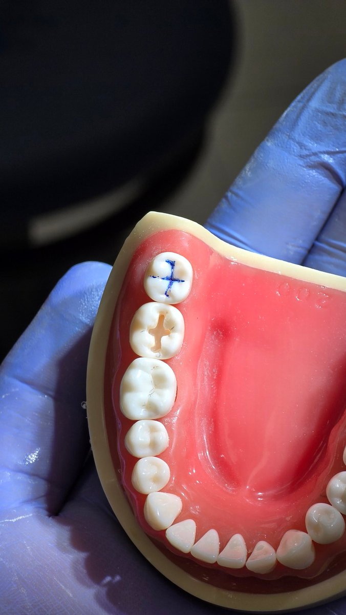 Drmoabd's tweet image. My first prep 😅
#47 Class I preparation 
#Dentistry