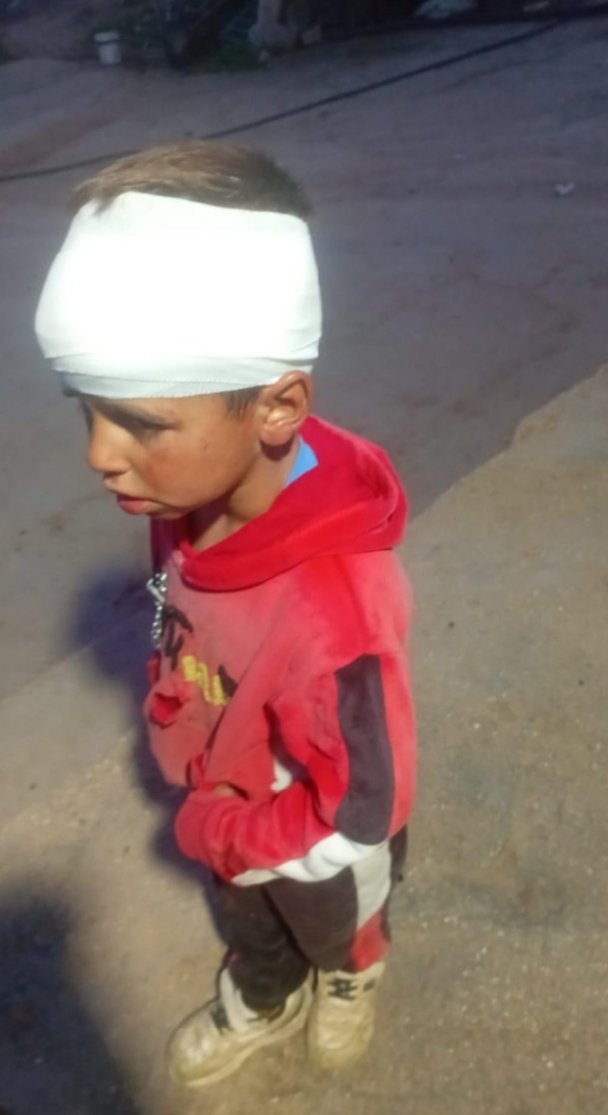 Este niño palestino tiene 5 años y los colonos le ha reventado la cabeza a golpes, asaltaron su aldea golpearon y gasearon a los residentes y luego les robaron las ovejas.
Es uno de los 10 ataques que realizaron ese día en Cisjordania, Palestina, ningún colono fue detenido.