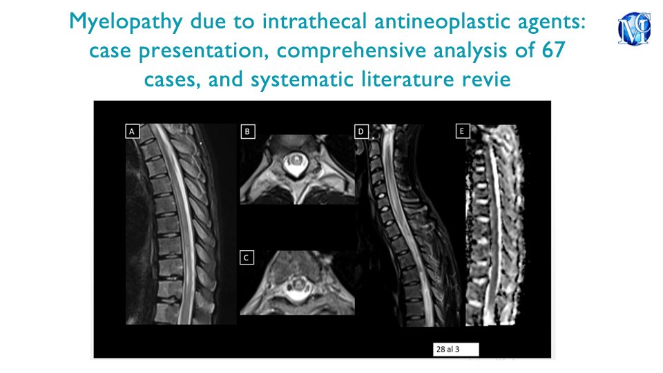 medcraveonline's tweet image. Myelopathy due to intrathecal antineoplastic agents: case presentation, comprehensive analysis of 67 cases, and systematic literature review, published in Journal of Neurology &amp;amp; Stroke by Jimenez Arango J, et al.
 medcraveonline.com/JNSK/JNSK-16-0…

#chemotherapy #neurotoxicity #radiology