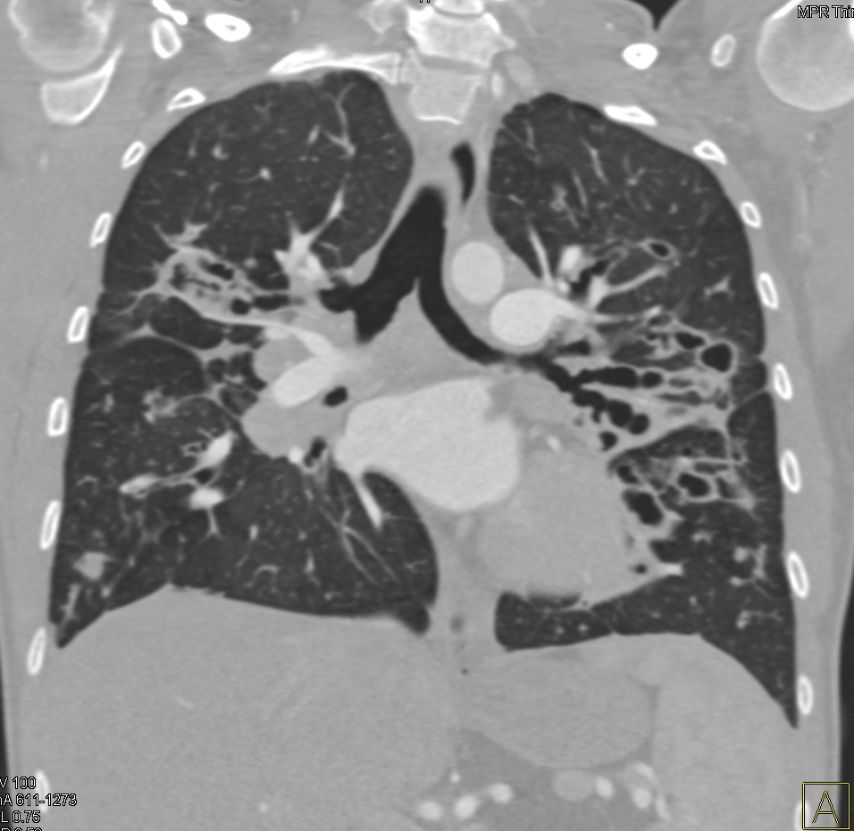 ctisus's tweet photo. Cystic Fibrosis with Bronchiectasis https://t.co/g3M7m8n4dp