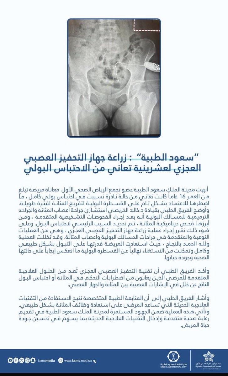 alzaagi1's tweet photo. تواصل #مدينة_الملك_سعود_الطبية إبراز تميزها في تقديم الرعاية التخصصية المتقدمة، حيث نجح الفريق الطبي في زراعة جهاز التحفيز العصبي العجزي لعشرينية تعاني من الاحتباس البولي، في إنجاز يعكس كفاءة الكوادر الطبية وتسخير التقنيات الحديثة لتحسين جودة الحياة والارتقاء بمستوى الرعاية الصحية. 👏🏻