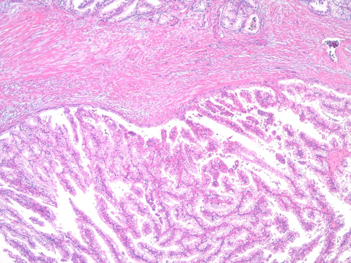 DrCycloPath's tweet image. #PathQuiz 🔬🧬 #KidneyPath

A) Clear Cell Renal Cell Carcinoma
B) Clear Cell Papillary Renal Cell Tumor
C) Fumarate Hydratase-Deficient RCC
D) ELOC (TCEB1)-mutated Renal Cell Carcinoma

#Pathology #GUPath #KidneyPath