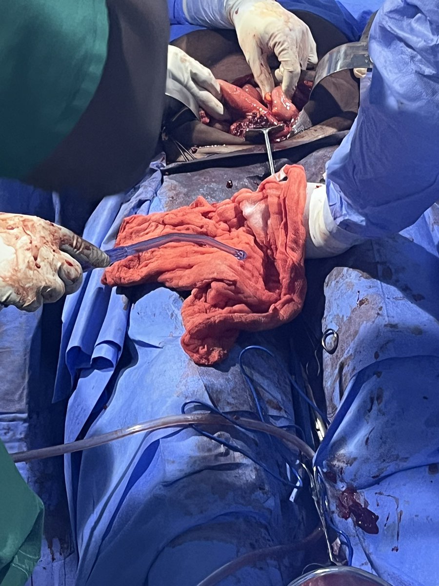 ItunuAkinpelu's tweet photo. Week 2, Day 1 — Obstetrics & Gynaecology (LUTH) ✨

Today in theatre: Staging laparotomy + omental biopsy

Great day in modular theatre, finally getting a solid grasp of ovarian cancer staging, hemorrhagic ascites, and key intraoperative findings. 

Every day, I’m learning to see beyond the textbooks and think like a doctor🥳