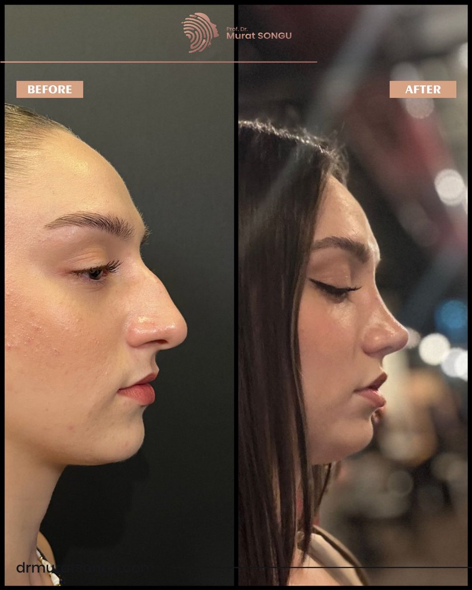 profmuratsongu's tweet photo. 📌  Primary Rhinoplasty in Turkey -  Before After 

Contact us to get an appointment and information in detail. 😊

For surgeries:  +90 532 1300316 

For medical aesthetic treatments: +90 532 1300317 

🌐 https://t.co/vhzB8m9cQV
📍 Izmir, Turkey https://t.co/T4dF6up9JH