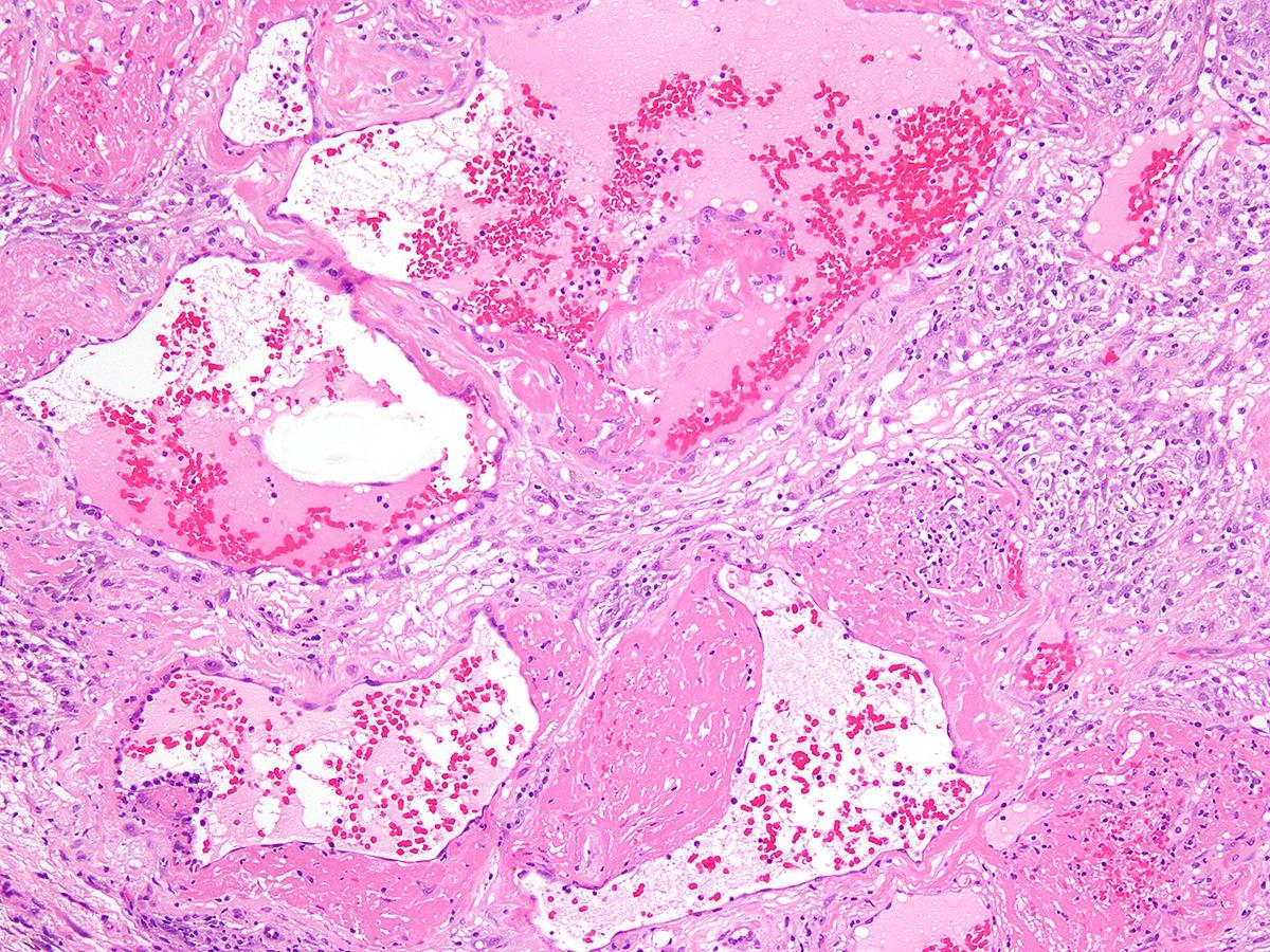 DrCycloPath's tweet image. #PathQuiz 🔬🩸 #SoftTissuePath

A) Deep Angiomyxoma
B) Hemosiderotic Fibrolipomatous Tumor
C) Myxoinflammatory Fibroblastic Sarcoma
D) Pleomorphic Hyalinizing Tumor

#Pathology #SoftTissuePath #DermPath