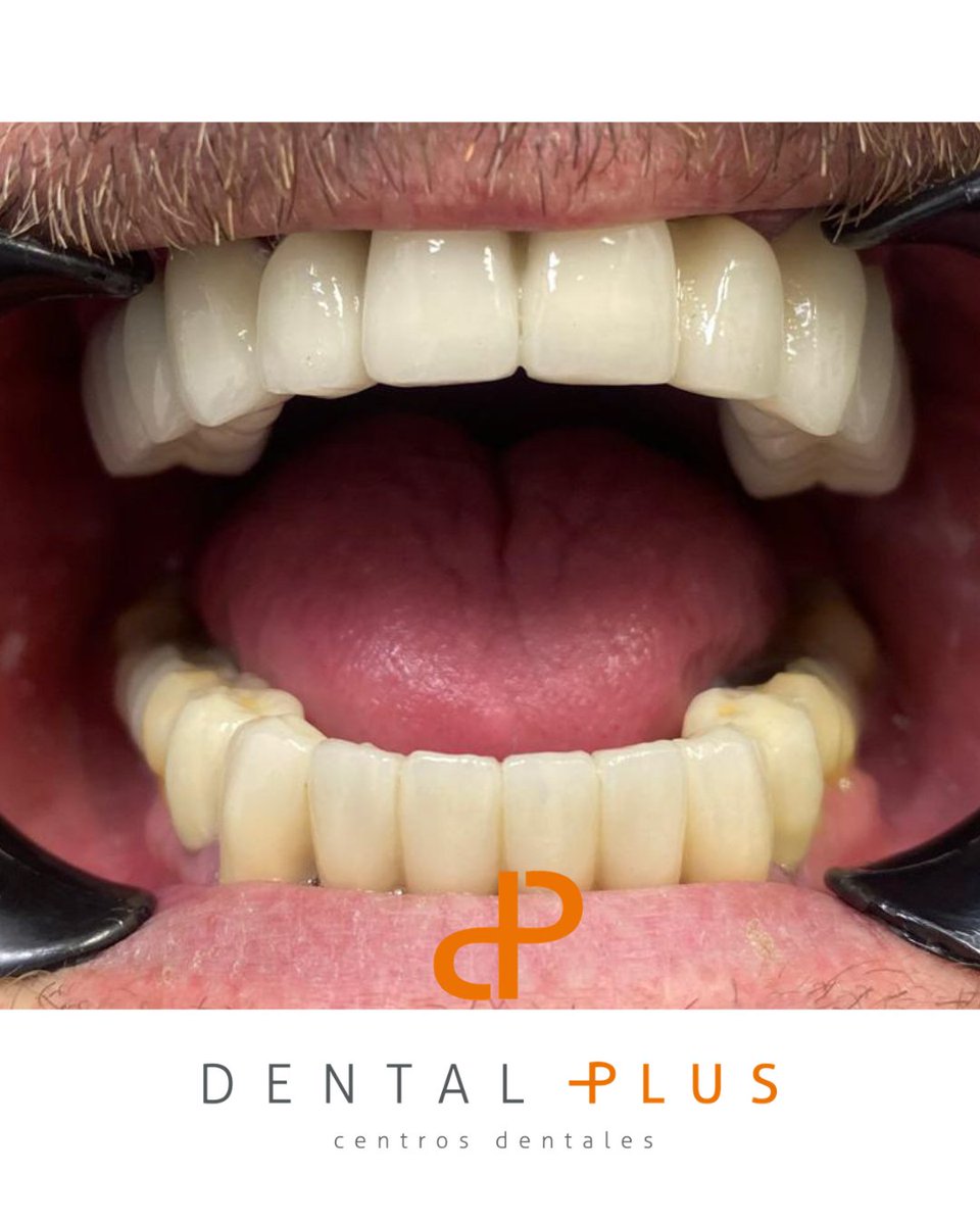 DentalplusPLUS's tweet photo. De una sonrisa marcada por la insalubridad y la falta de estética… a un resultado armónico, saludable y natural 😁✨
Este caso refleja cómo un tratamiento adecuado no solo mejora la salud bucodental, sino también la confianza y la calidad de vida del paciente 😷 https://t.co/sCFoRnirrH